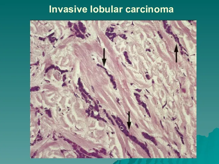 Invasive lobular carcinoma