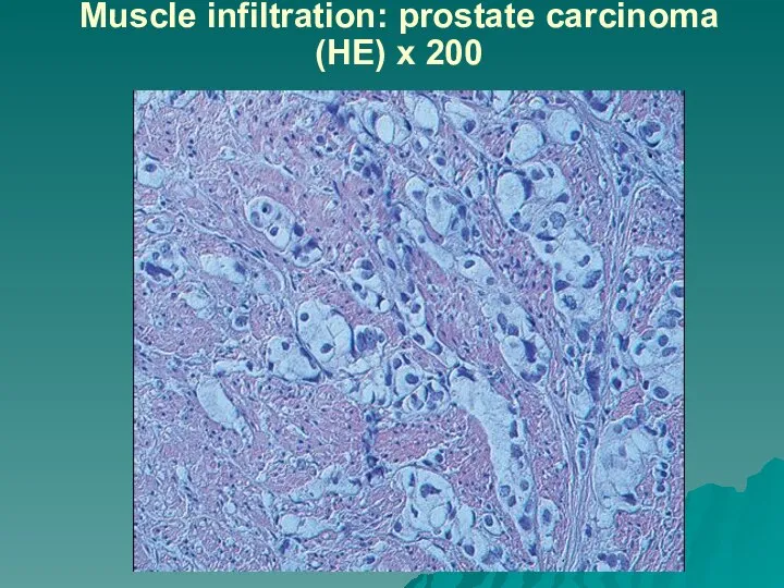 Muscle infiltration: prostate carcinoma (HE) x 200
