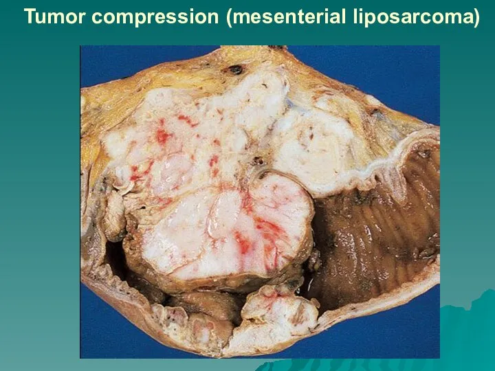 Tumor compression (mesenterial liposarcoma)