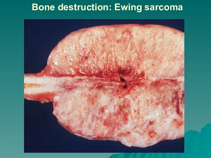 Bone destruction: Ewing sarcoma