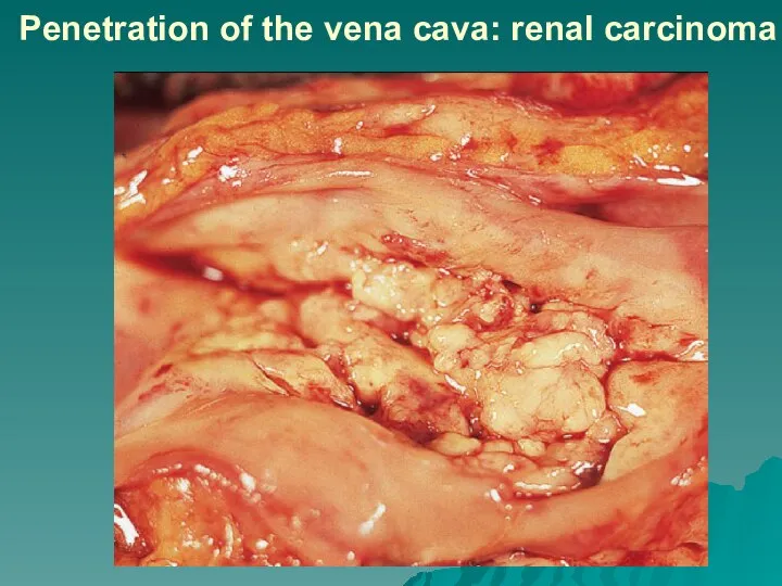 Penetration of the vena cava: renal carcinoma