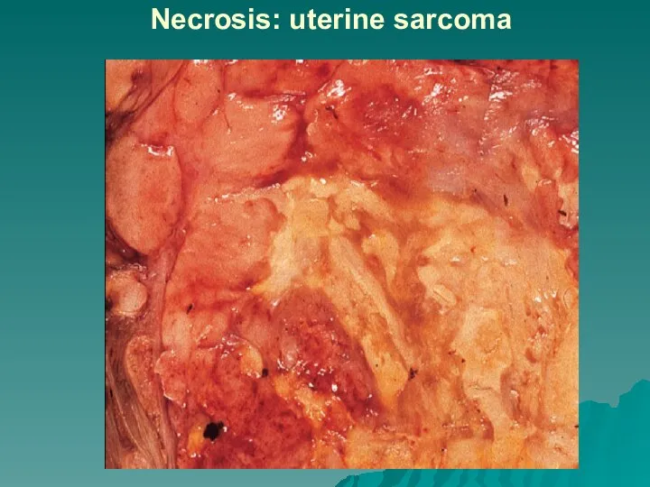 Necrosis: uterine sarcoma