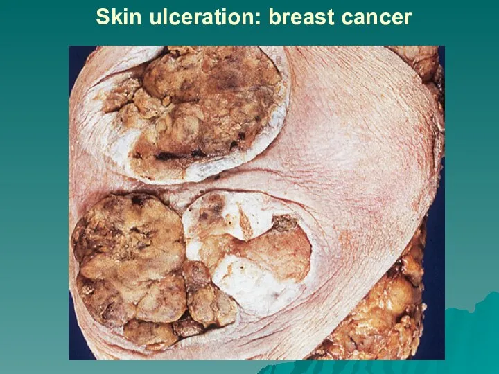 Skin ulceration: breast cancer