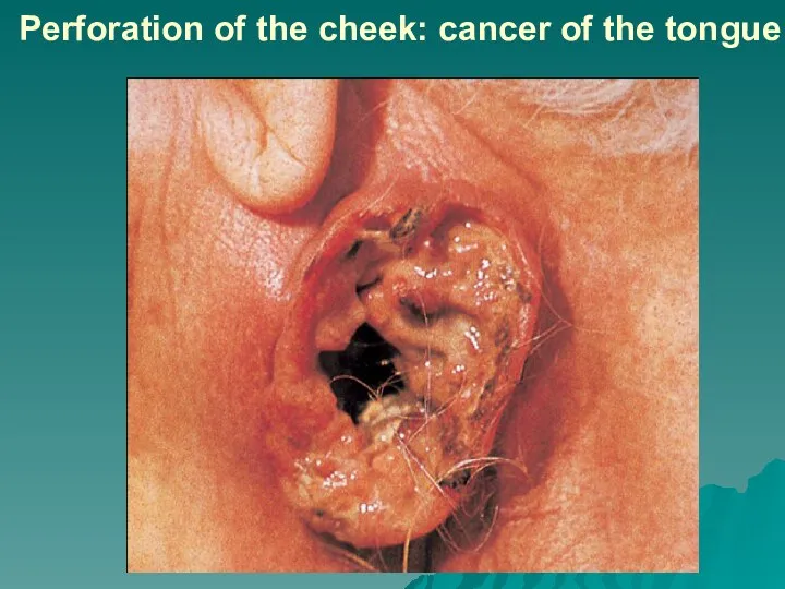 Perforation of the cheek: cancer of the tongue
