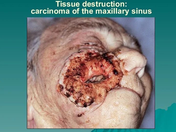 Tissue destruction: carcinoma of the maxillary sinus