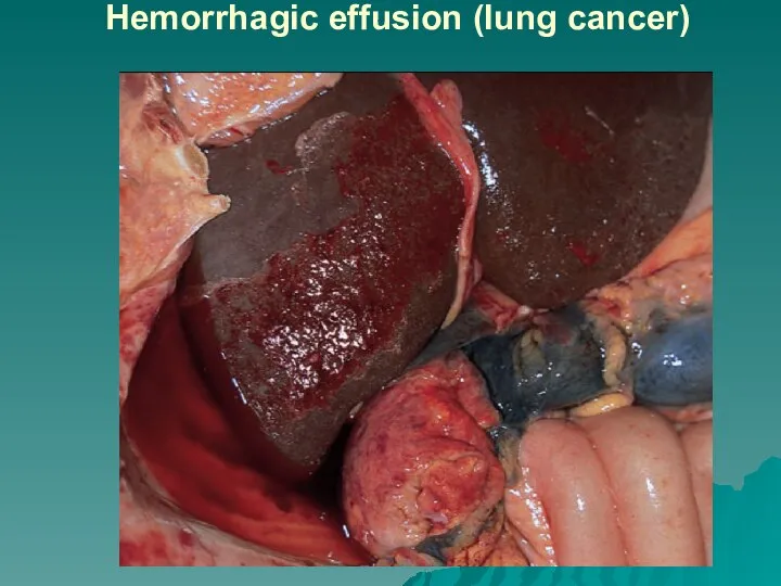 Hemorrhagic effusion (lung cancer)