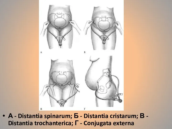 А - Distantia spinarum; Б - Distantia cristarum; В - Distantia trochanterica; Г - Conjugata externa