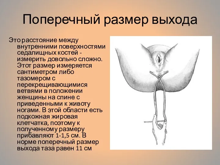 Поперечный размер выхода Это расстояние между внутренними поверхностями седалищных костей - измерить