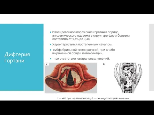 Дифтерия гортани Изолированное поражение гортани в период эпидемического подъема в структуре форм