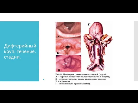 Дифтерийный круп: течение, стадии. .