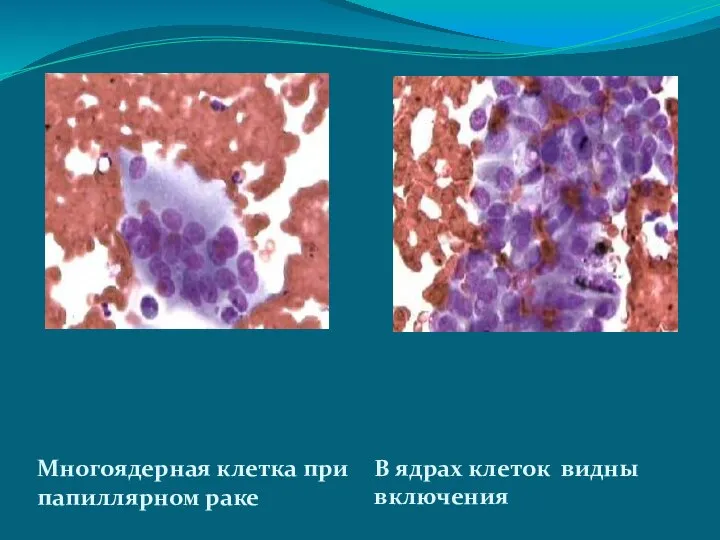 Многоядерная клетка при папиллярном раке В ядрах клеток видны включения