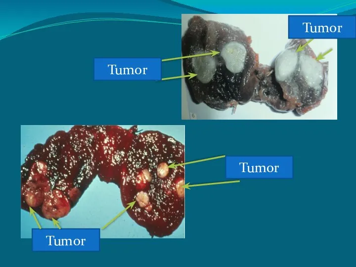Tumor Tumor Tumor Tumor