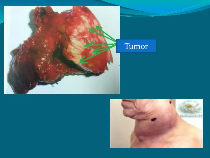 Tumor