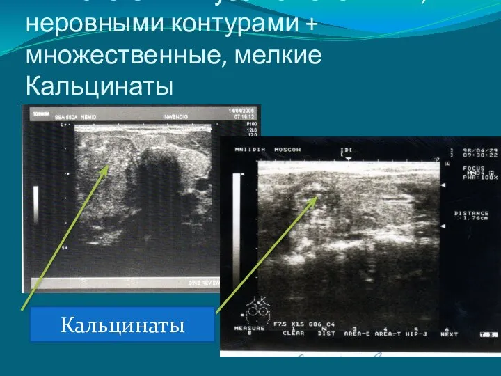 ИЗОэхогенный узел с нечеткими, неровными контурами + множественные, мелкие Кальцинаты Кальцинаты