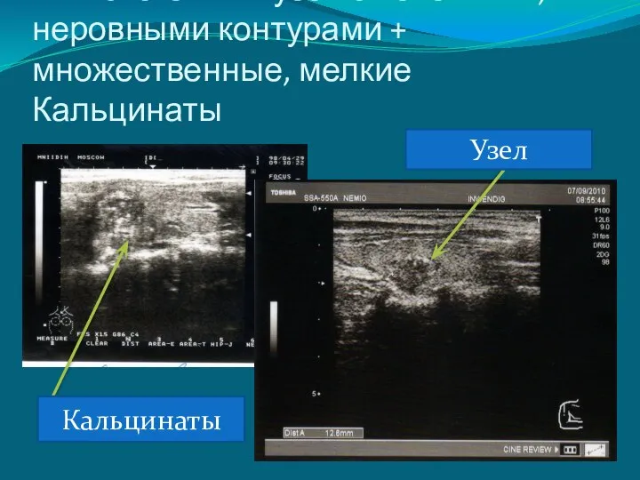 ИЗОэхогенный узел с нечеткими, неровными контурами + множественные, мелкие Кальцинаты Кальцинаты Узел