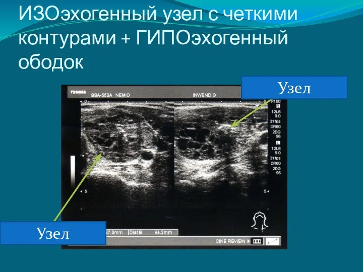 ИЗОэхогенный узел с четкими контурами + ГИПОэхогенный ободок Узел Узел