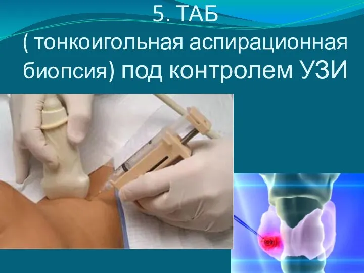 5. ТАБ ( тонкоигольная аспирационная биопсия) под контролем УЗИ