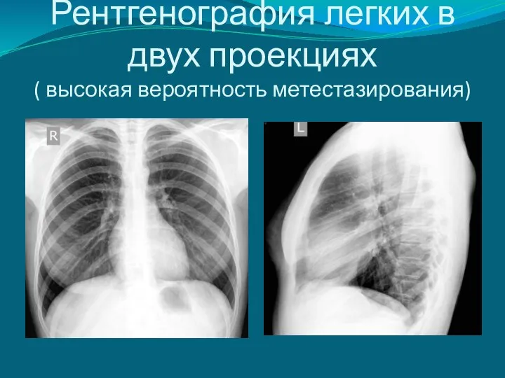 Рентгенография легких в двух проекциях ( высокая вероятность метестазирования)