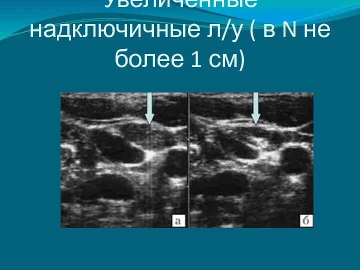 Увеличенные надключичные л/у ( в N не более 1 см)