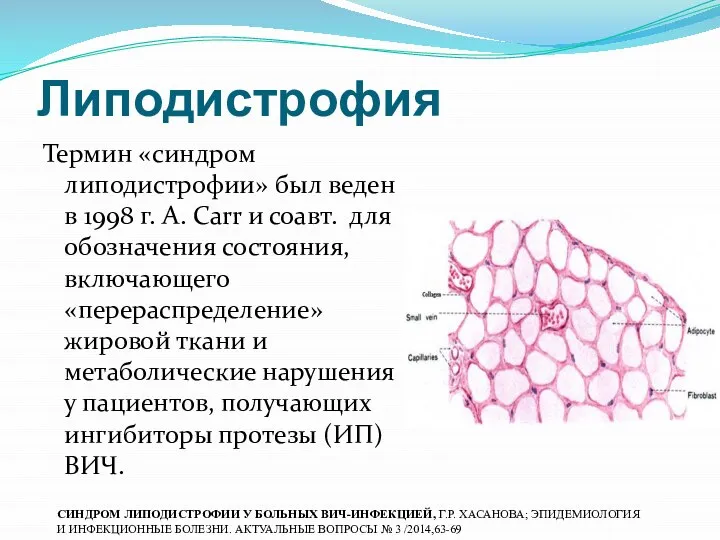 Липодистрофия Термин «синдром липодистрофии» был веден в 1998 г. А. Carr и