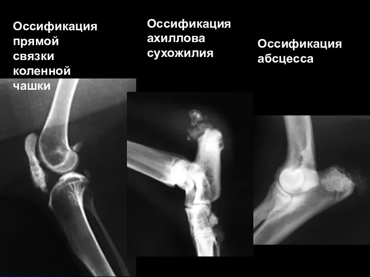 Оссификация прямой связки коленной чашки Оссификация ахиллова сухожилия Оссификация абсцесса