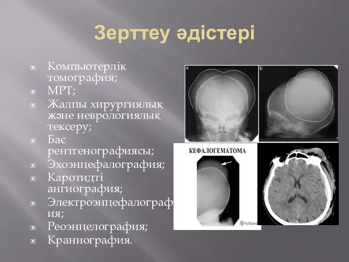 Зерттеу әдістері Компьютерлік томография; МРТ; Жалпы хирургиялық және неврологиялық тексеру; Бас рентгенографиясы;