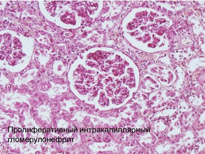 Пролиферативный интракапиллярный гломерулонефрит