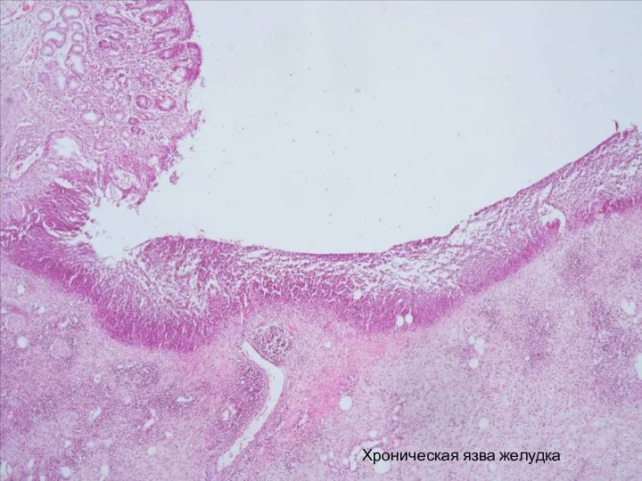 Хроническая язва желудка