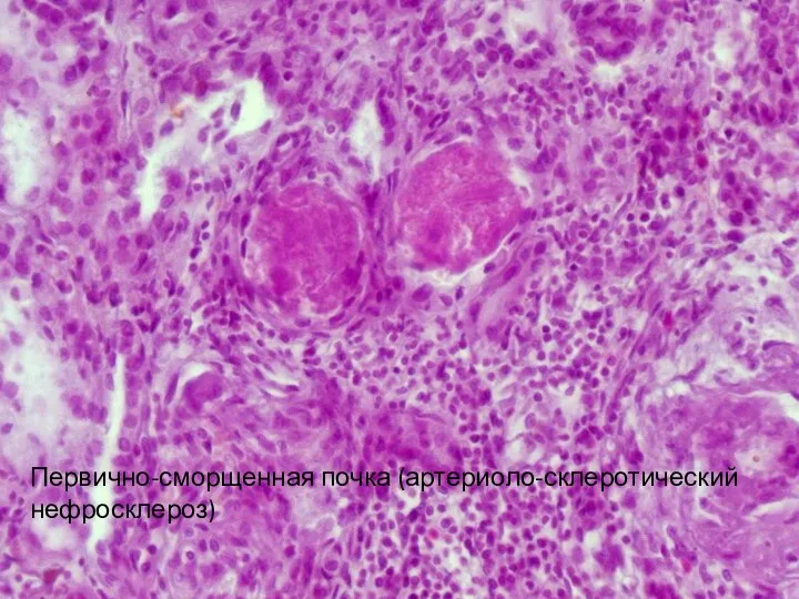 Первично-сморщенная почка (артериоло-склеротический нефросклероз)