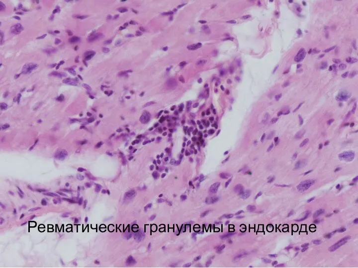 Ревматические гранулемы в эндокарде