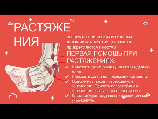 РАСТЯЖЕНИЯ возникает при резких и сильных движениях в местах, где мышцы прикрепляются