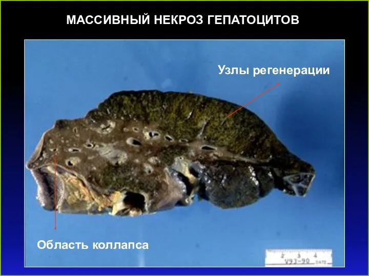 МАССИВНЫЙ НЕКРОЗ ГЕПАТОЦИТОВ Узлы регенерации Область коллапса