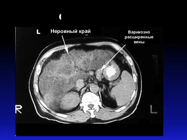 Неровный край Варикозно расширенные вены