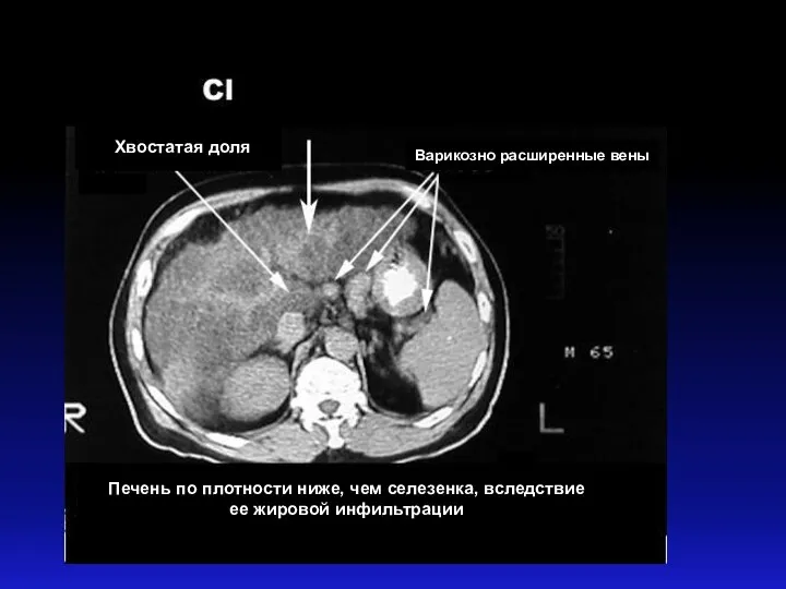 Печень по плотности ниже, чем селезенка, вследствие ее жировой инфильтрации Хвостатая доля Варикозно расширенные вены