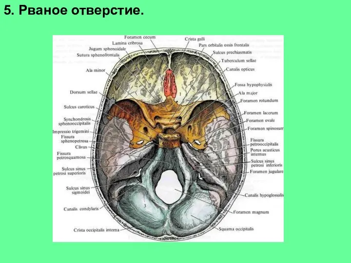 5. Рваное отверстие.