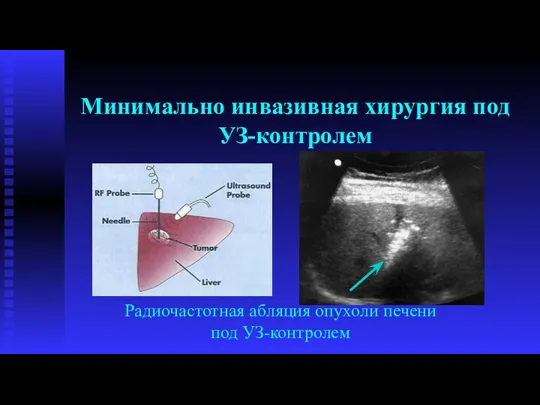 Радиочастотная абляция опухоли печени под УЗ-контролем Минимально инвазивная хирургия под УЗ-контролем