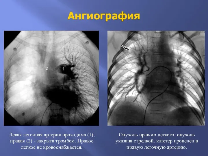 Ангиография Левая легочная артерия проходима (1), правая (2) - закрыта тромбом. Правое
