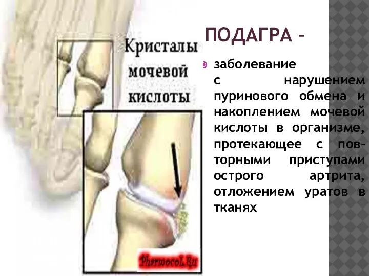 ПОДАГРА – заболевание с нарушением пуринового обмена и накоплением мочевой кислоты в