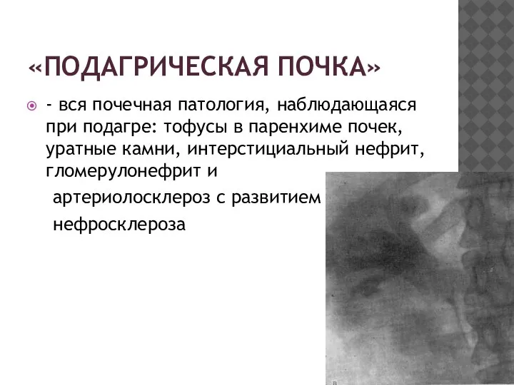 «ПОДАГРИЧЕСКАЯ ПОЧКА» - вся почечная патология, наблюдающаяся при подагре: тофусы в паренхиме