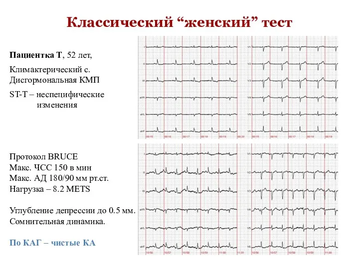 Пациентка Т, 52 лет, Климактерический с. Дисгормональная КМП ST-T – неспецифические изменения