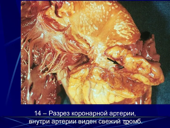 14 – Разрез коронарной артерии, внутри артерии виден свежий тромб. 14 –