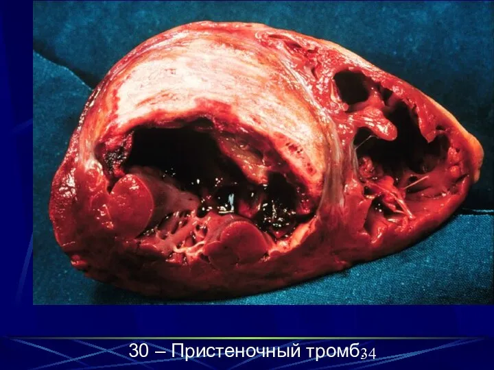 30 – Пристеночный тромб. 30 – Пристеночный тромб.