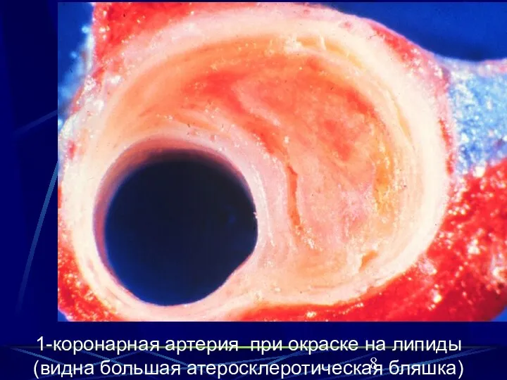 1-коронарная артерия при окраске на липиды (видна большая атеросклеротическая бляшка) 1-коронарная артерия