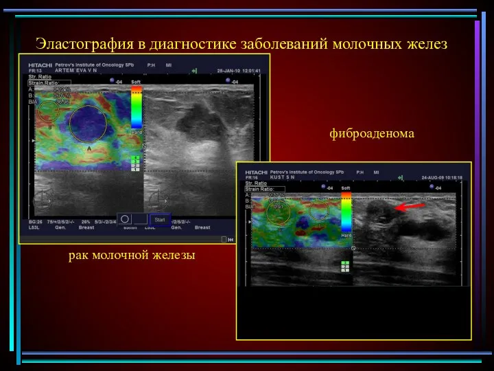 рак молочной железы фиброаденома Эластография в диагностике заболеваний молочных желез