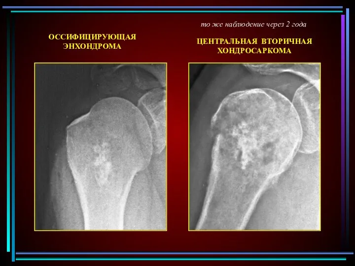 ОССИФИЦИРУЮЩАЯ ЭНХОНДРОМА то же наблюдение через 2 года ЦЕНТРАЛЬНАЯ ВТОРИЧНАЯ ХОНДРОСАРКОМА