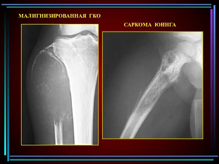 МАЛИГНИЗИРОВАННАЯ ГКО САРКОМА ЮИНГА
