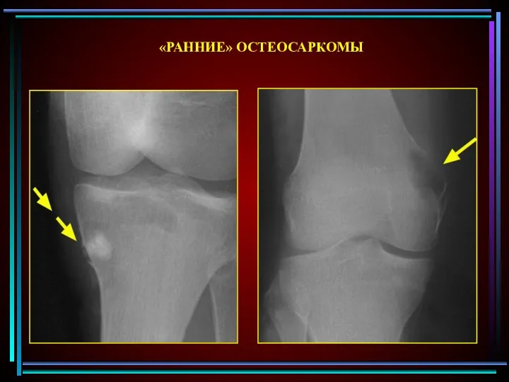 «РАННИЕ» ОСТЕОСАРКОМЫ