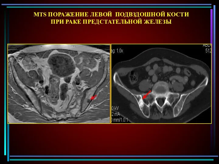 MTS ПОРАЖЕНИЕ ЛЕВОЙ ПОДВЗДОШНОЙ КОСТИ ПРИ РАКЕ ПРЕДСТАТЕЛЬНОЙ ЖЕЛЕЗЫ