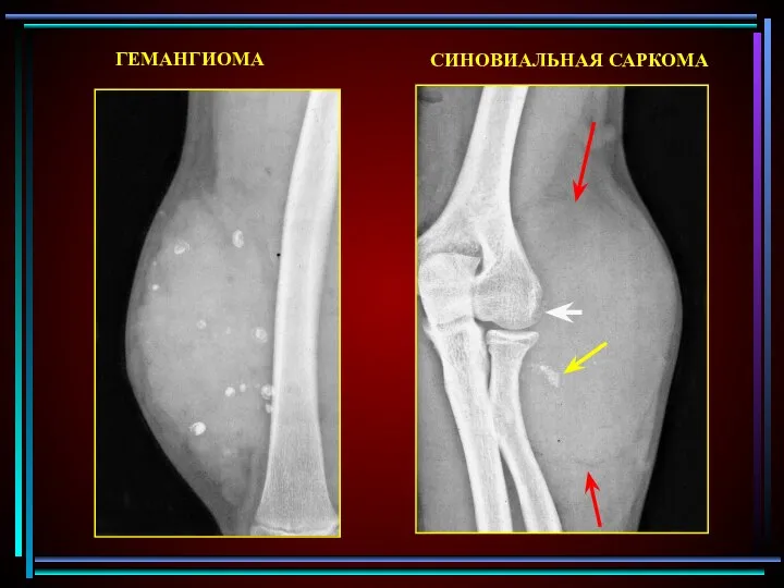 ГЕМАНГИОМА СИНОВИАЛЬНАЯ САРКОМА