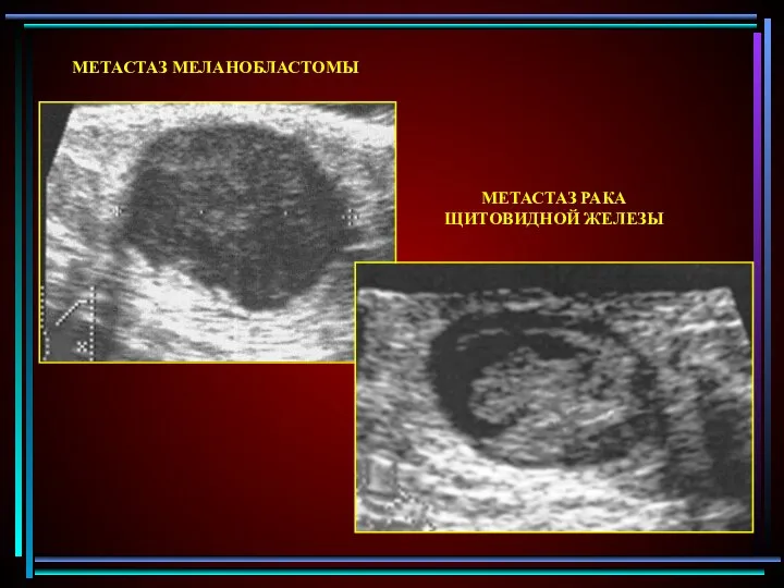МЕТАСТАЗ МЕЛАНОБЛАСТОМЫ МЕТАСТАЗ РАКА ЩИТОВИДНОЙ ЖЕЛЕЗЫ